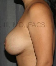 Breast Augmentation Revision before and after - after
