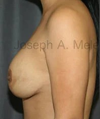 Breast Augmentation Revision before and after - before