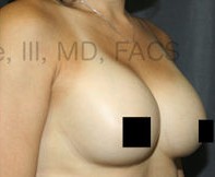 Breast Augmentation Revision before and after - after