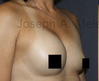 Breast Augmentation Revision before and after - before