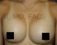 Breast Augmentation Revision before and after - after