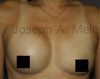 Breast Augmentation Revision before and after - before