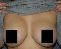 Breast Augmentation Revision before and after - after