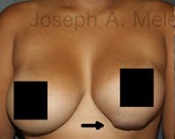 Breast Augmentation Revision before and after - before