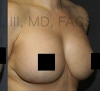 Breast Augmentation Revision before and after - after