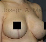 Breast Augmentation Revision before and after - before