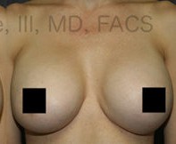 Breast Augmentation Revision before and after - after