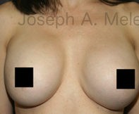 Breast Augmentation Revision before and after - before