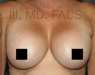 Breast Augmentation Revision before and after - after