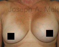 Breast Augmentation Revision before and after - before