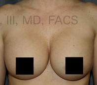 Breast Augmentation Revision before and after - after