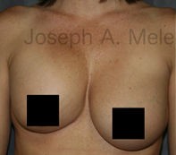 Breast Augmentation Revision before and after - before