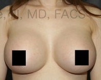 Breast Augmentation Revision before and after - after