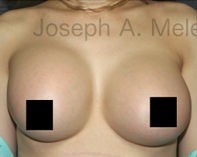 Breast Augmentation Revision before and after - before