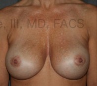 Breast Augmentation Revision before and after - after