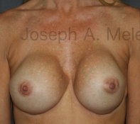 Breast Augmentation Revision before and after - before