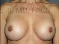 Breast Augmentation Revision before and after - after