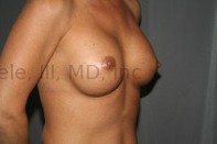 Breast Augmentation Revision before and after - after