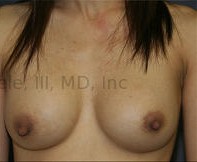 Breast Augmentation Revision before and after - after