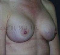 Breast Augmentation Revision before and after - after