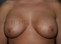 Breast Augmentation Revision before and after - after