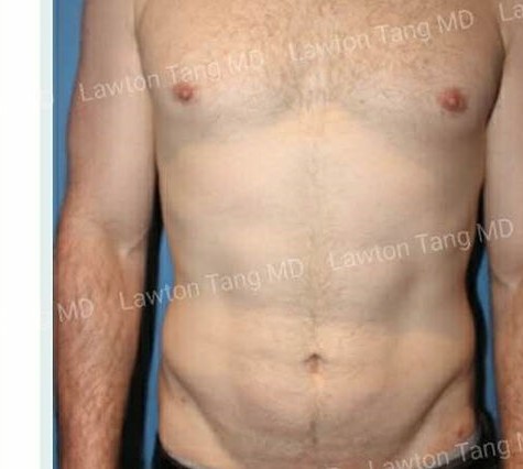 Liposuction, Tummy Tuck before and after - after