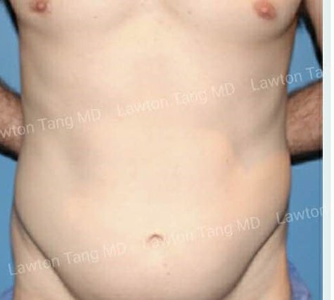 Liposuction, Tummy Tuck before and after - before