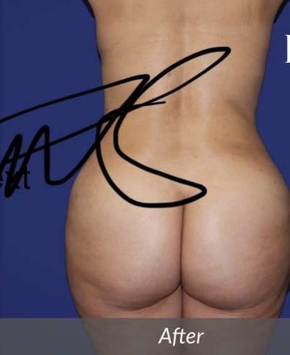 Brazilian Butt Lift before and after - after