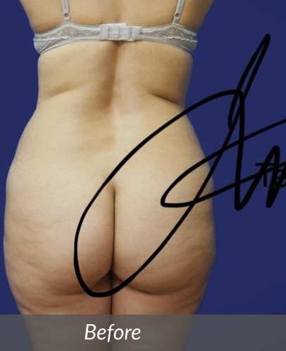Brazilian Butt Lift before and after - before