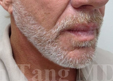 Face/Neck Lift before and after - after