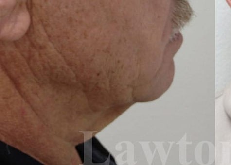 Face/Neck Lift before and after - before