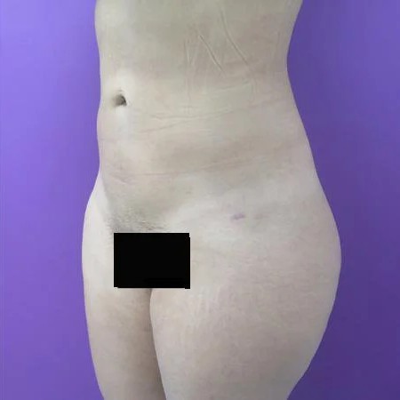 Liposuction before and after - after