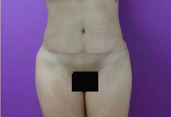Tummy Tuck before and after - after