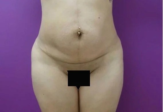 Tummy Tuck before and after - before