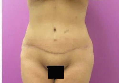 Tummy Tuck before and after - after