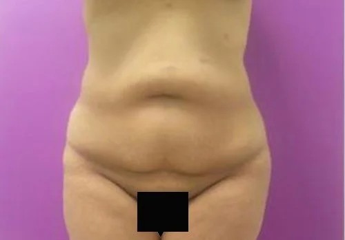 Tummy Tuck before and after - before