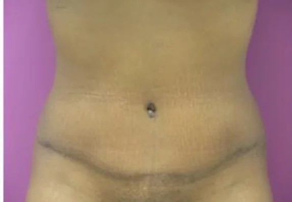 Tummy Tuck before and after - after