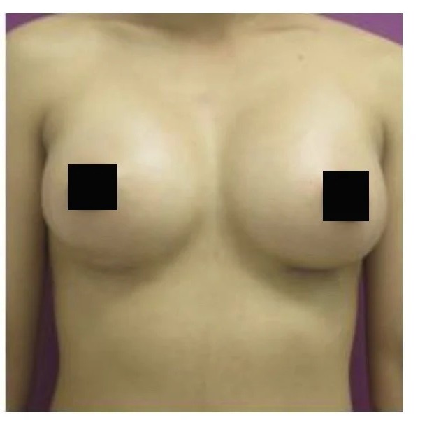Breast Augmentation before and after - after