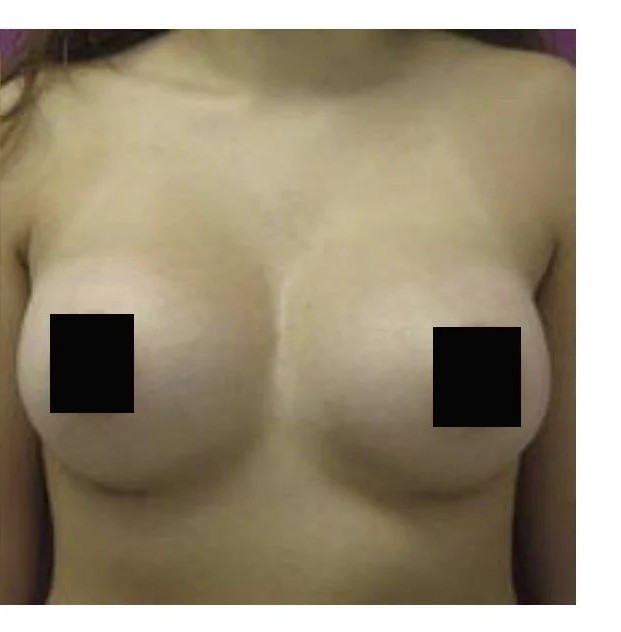 Breast Augmentation before and after - after