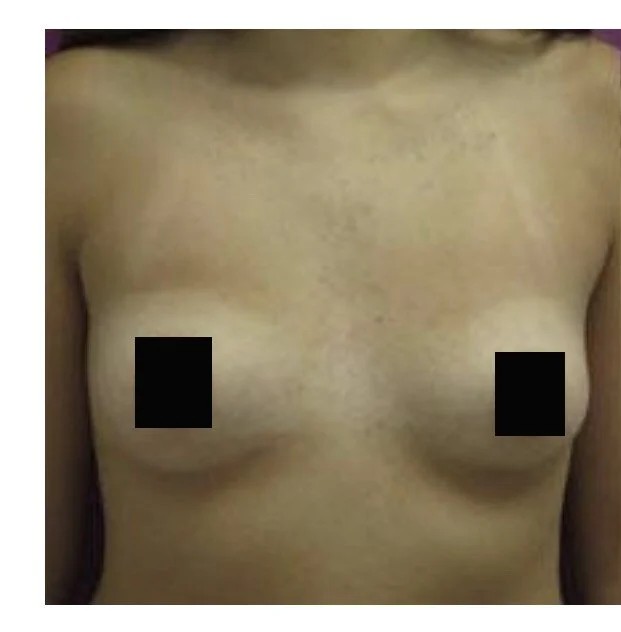 Breast Augmentation before and after - before