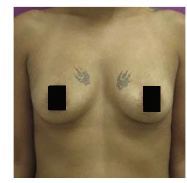 Breast Augmentation before and after - before