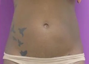 Liposuction before and after - after