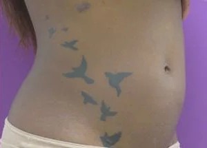Liposuction before and after - after