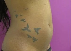 Liposuction before and after - before