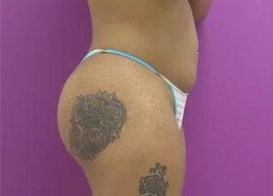 Liposuction before and after - before