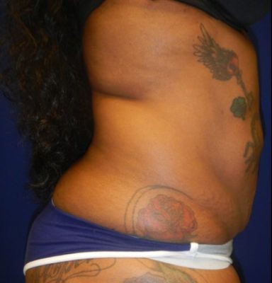 Liposuction before and after - before