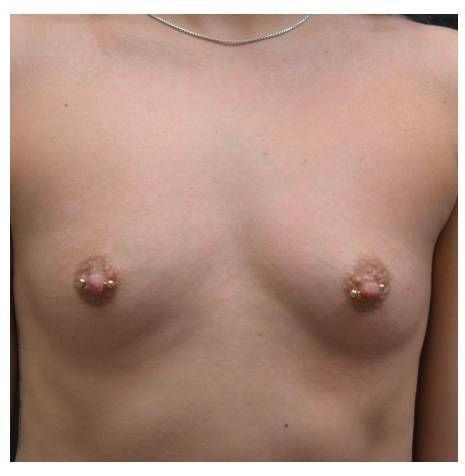 Breast Augmentation before and after - before