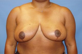 Breast Reduction before and after - after