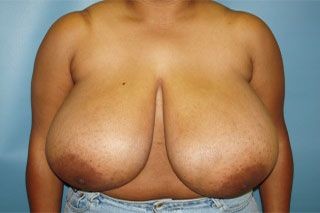 Breast Reduction before and after - before