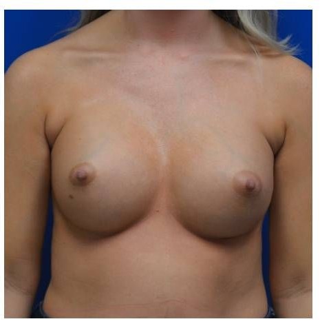 Breast Augmentation before and after - after
